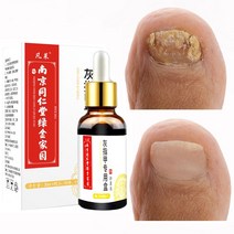 무좀 내성발톱 발톱무좀 손톱 곰팡이 치료 발 관리 에센스 감염 방지 진균증 발가락 제거 젤 제품, 한개옵션0