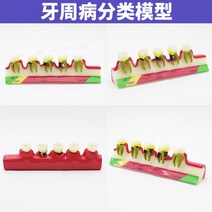 치아모형 인체모형도 치과기구 실리콘몰드 인체모형 양치교구 재료상, 치주 분류 모델