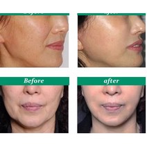 얼굴 리프팅 기계 마사지기 미용기기 입술 주사기 보톡스 필러 3D 조각 LED 조명 사인 소매 메디, 04 Latox 100u