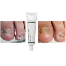 발톱 무좀 가려움 연고 30ml, 2+무좀비누