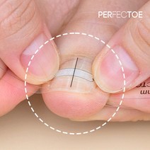[특허청 실안신용 의료기기] 퍼펙토 내성발톱 교정 자가치료 스트립 세트, 14mm 세트